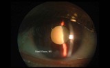 78.Hypermature Morgagnian Cataract.