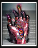 Carpal tunnel syndrome