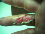 LUKE'S FINGER SKINNED