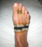 toe taped into slight plantar flexion