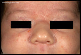 ACNE NEONATORUM.jpg