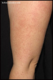 KERATOSIS PILARIS-01.JPG