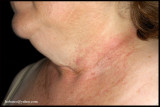 MILIARIA RUBRA_03.JPG
