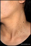 PSEUDOACANTHOSIS NIGRICANS_03.jpg