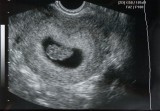 Ultrasound - Dec 15, 2009