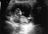 Ultrasound - Jan 11, 2010 - #3
