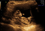 Ultrasound - Jan 11, 2010 - #4