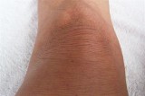 ACA Knee close up-no. 7.jpg