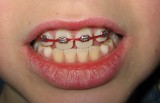 braces 004c 800x600.jpg