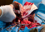 Suturing tissue after removal of a tumor.  L1016272.jpg