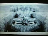 Panoramic X- Ray or Panorex