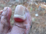 1Say Goodbye Toenail.jpg