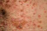 eczema herpeticum impetiginized 02.jpg