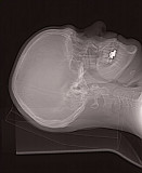 Alberts Brain by Telluride Emergency Medical Clinic Technician