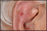 SQUAMOUS CELL CARCINOMA OF THE EAR_02.jpg