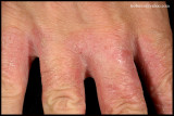 IRRITANT CONTACT DERMATITIS_02.JPG