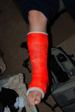 Broken Ankle
