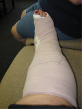 Broken Ankle