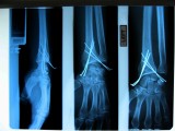 my arm on the inside