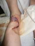 September 9th, Three Days After Surgery