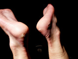 Nathalie's blisters