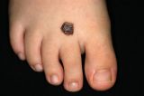 CONGENITAL MELANOCYTIC NAEVUS
