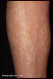 hypomelanosis01.jpg