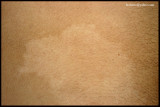 nevus depigmentosus_02.JPG