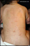 URTICARIA PIGMENTOSA_04.JPG