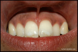 PIGMENTED TEETH+LABIAL MUCOSAE+GUMS.JPG