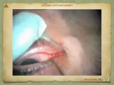 Lacrimal Outflow Surgery.029.jpeg