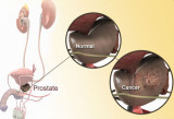 prostate-cancerprostate-diagram