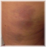 Rosey allergic reaction zoom thigh fall 2011.JPG