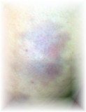 bruises from scratching fall 2011.JPG