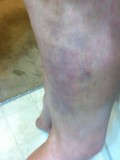 more bruises from scratching Jan 22 2013.JPG
