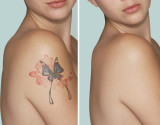 Laser Tattoo Removal for the Best Results