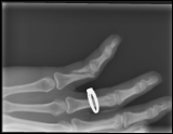 fractured pinky -  10_45_55 PM 7_7_2013 001.png