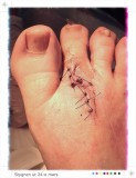 Stitches out three weeks after surgery