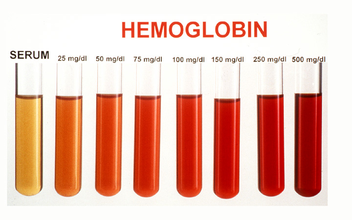 Composite photo for laboratory hemoglobin chart.