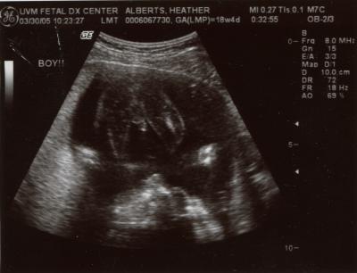 It's a boy!  - 18 weeks