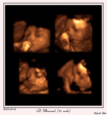 3D Ultrasound