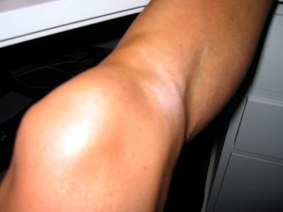 the medial hamstring tendon insertions are clearly visible, as is the atrophy of the medial thigh and calf