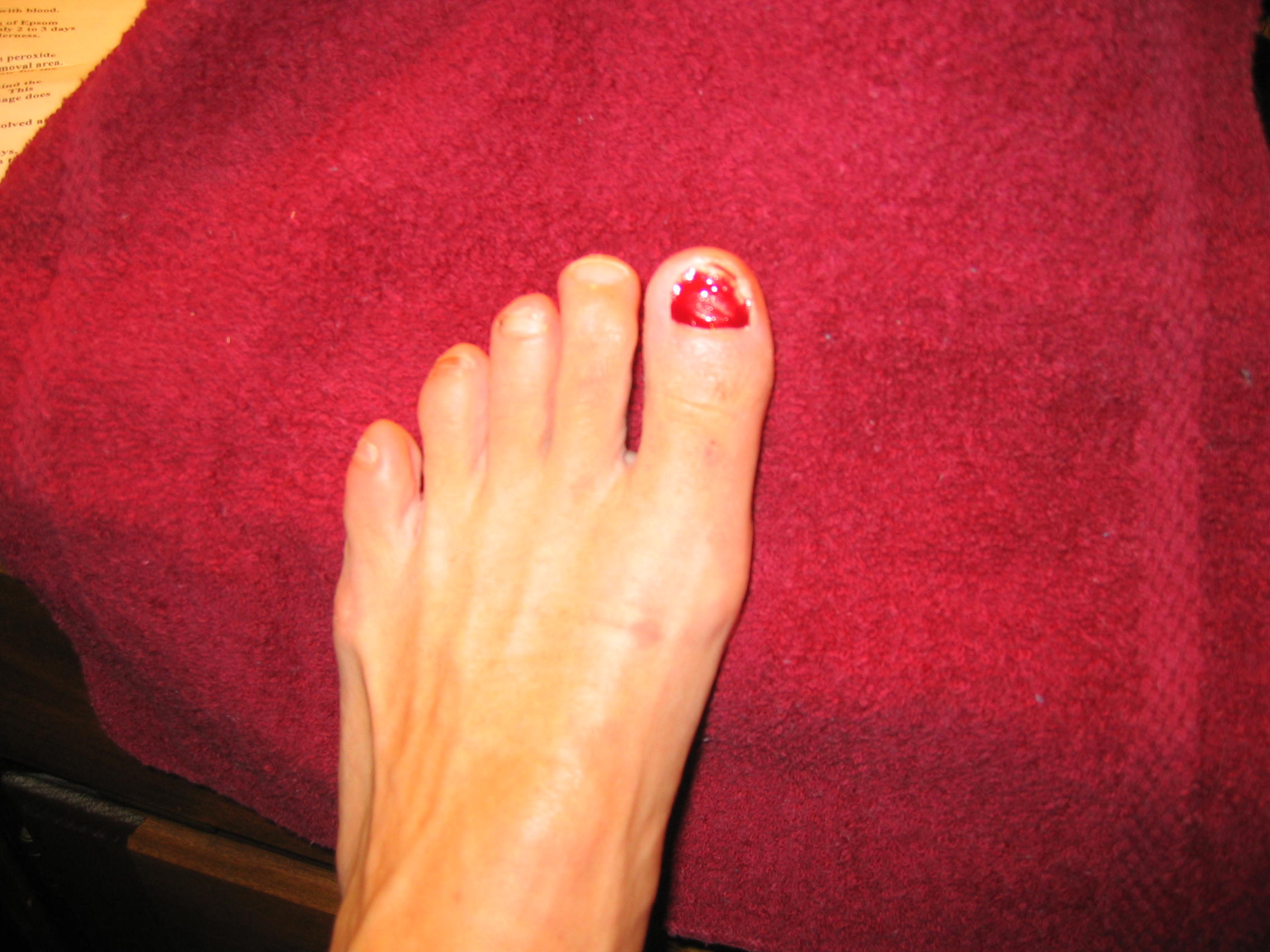 Day 1:  toenail removed and phenol applied to burn the nail bed.