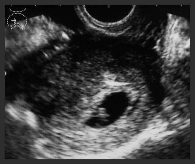 five week live fetus