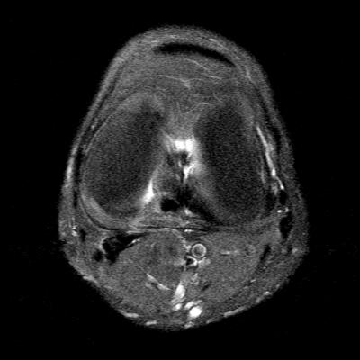 MRI axial left knee (1): thinning of the skin on the medial side and mild subcutaneous fluid