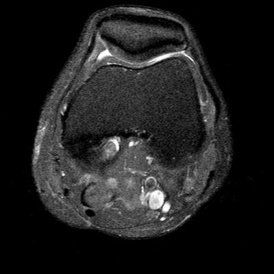 MRI axial left knee (2): Thin and incompetent medial patellofemoral ligament