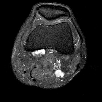 MRI axial left knee (3): the start of multilobulated perimeniscal cysts
