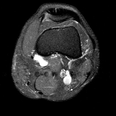 MRI axial left knee (5)