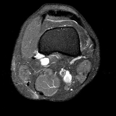 MRI axial left knee (6)