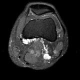 MRI axial left knee (4): the cysts grow & appear to be around the origin of the medial gastroc